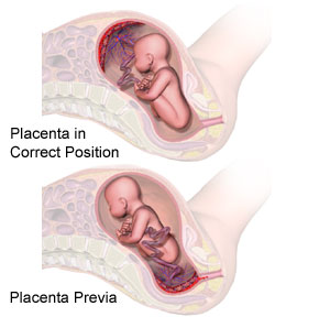 What is placenta previa?