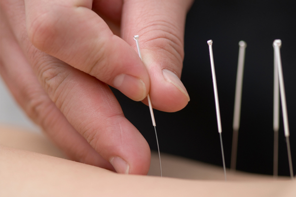 Acupunture