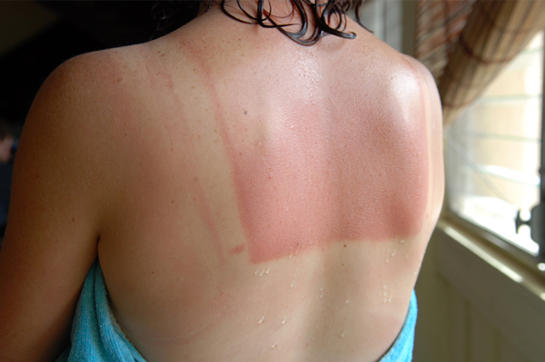 Woman with sunburn