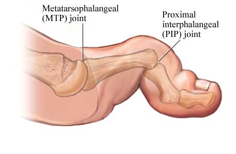 Hammer Toe Pain