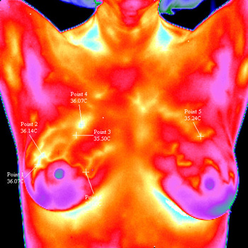 Breast thermography