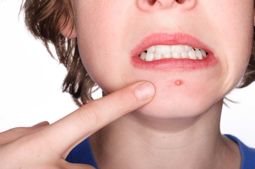 Teen with acne