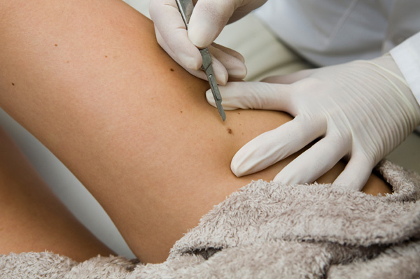 Woman having mole removed