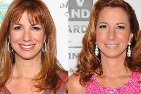 Jill Zarin plastic surgery