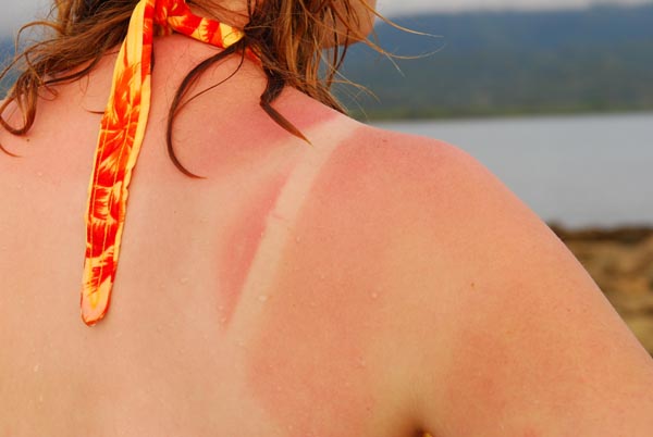 sunburned-woman