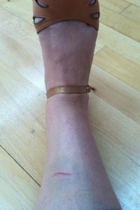 Ricki Lake injury
