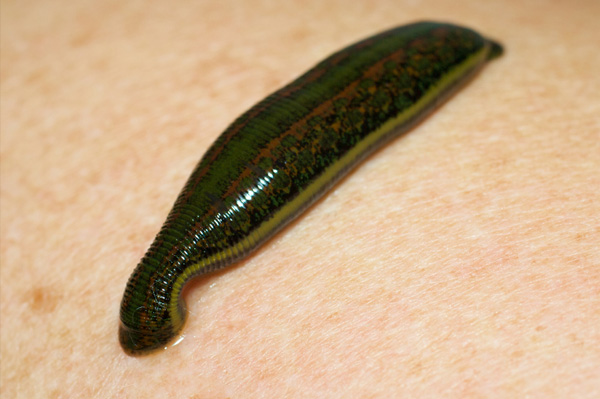 Leech therapy