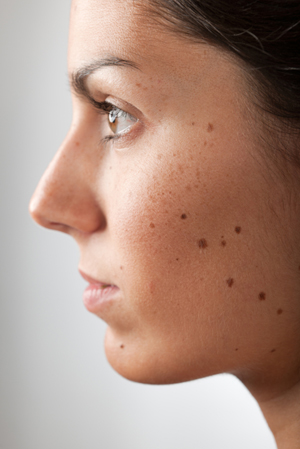 Use sunscreen to keep freckles and moles under control