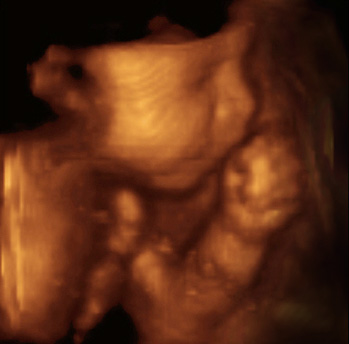 Second trimester ultrasound