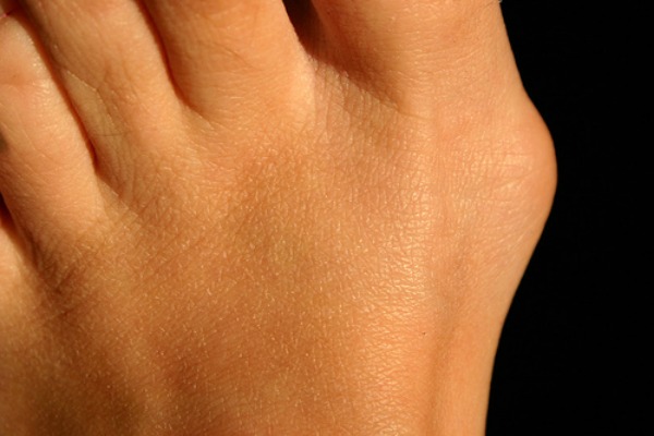 Foot pain from bunions
