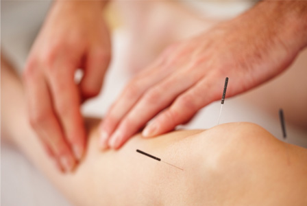 Woman getting accupuncture