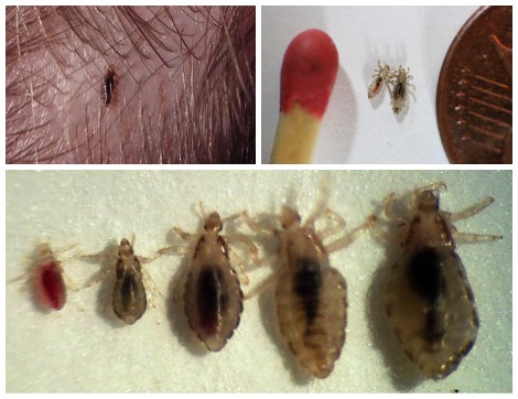 5 Things You Need To Know About Head Lice