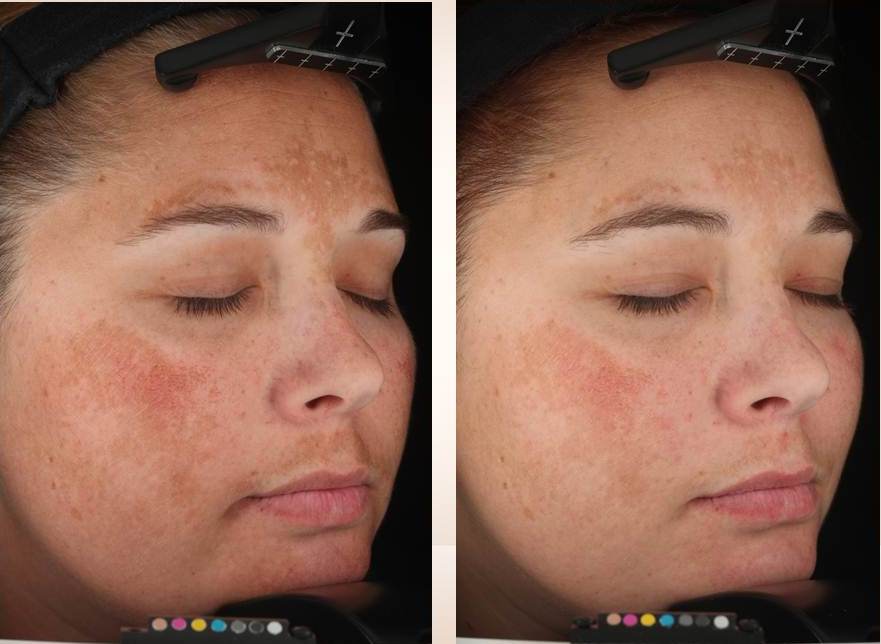 What is the best treatment for melasma?