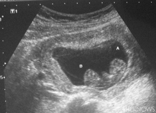 Emily's sonogram
