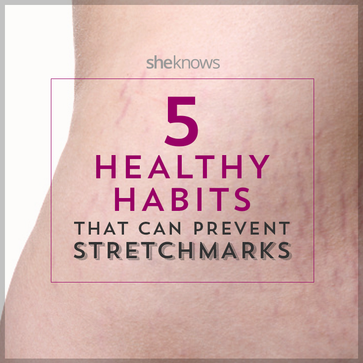 5 Ways to battle stretch marks during pregnancy before they start