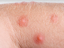 How to treat spider bites