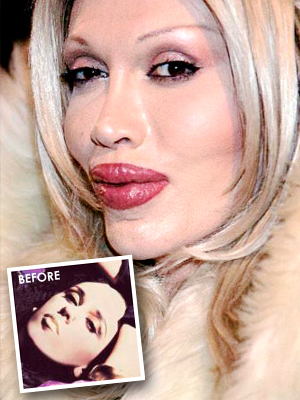 Plastic Surgery Gone Bad. had bad plastic surgery