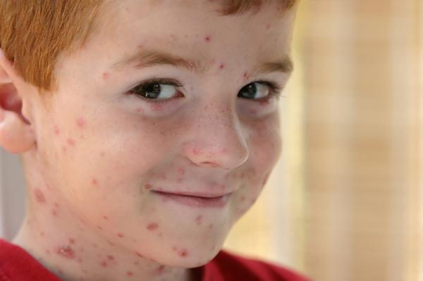 chicken pox scars. Boy with chickenpox