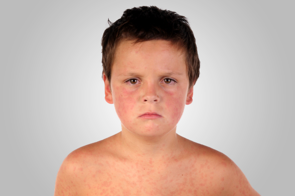 Measles Vaccine Rash