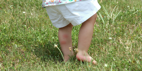 Little Girl with Bug Bites