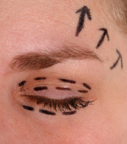 Eye lift