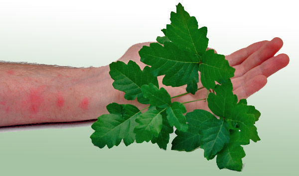 poison oak rash vs poison ivy. Poison oak/ivy rash