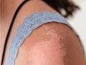 Dealing with sunburned, peeling skin