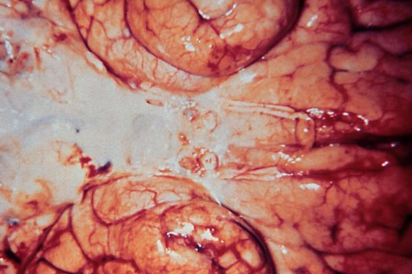 Bacterial Meningitis Brain