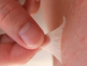 Dealing with sunburned, peeling skin