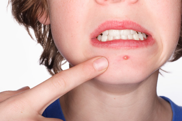 Aiutando il vostro adolescente a occuparsi dell'acne