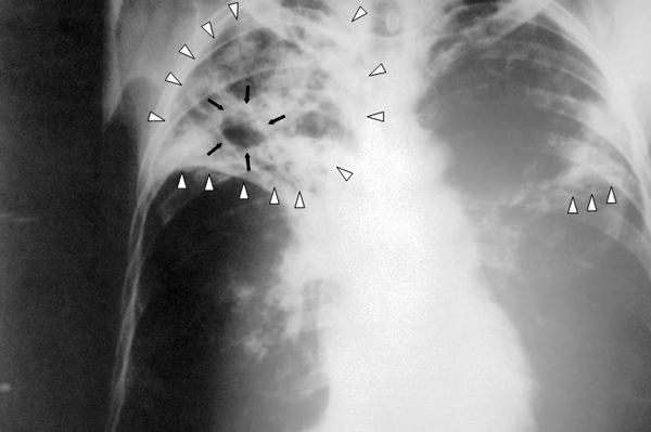 Tuberculosis+symptoms+pictures